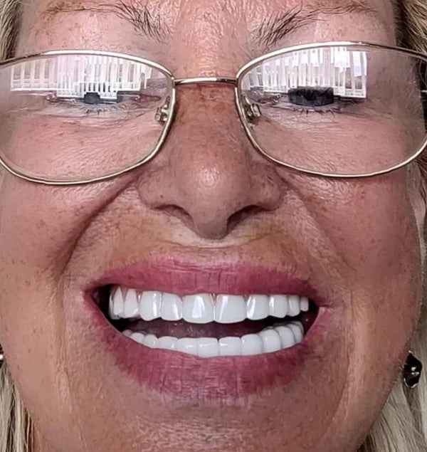 Carillas Dentales Snap On Smile